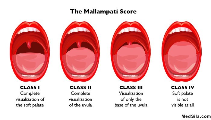 маллампати тест